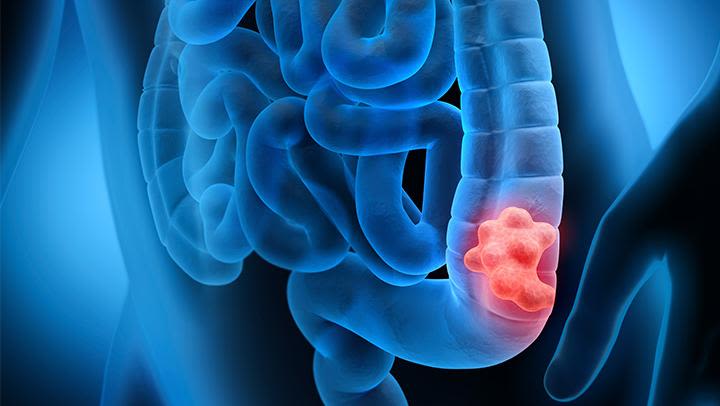 Bowel Cancer highlighted in the body