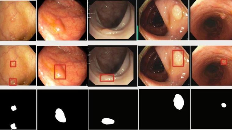 Stills from colonoscopy videos showing outputs of polyp detection and segmentation algorithms.