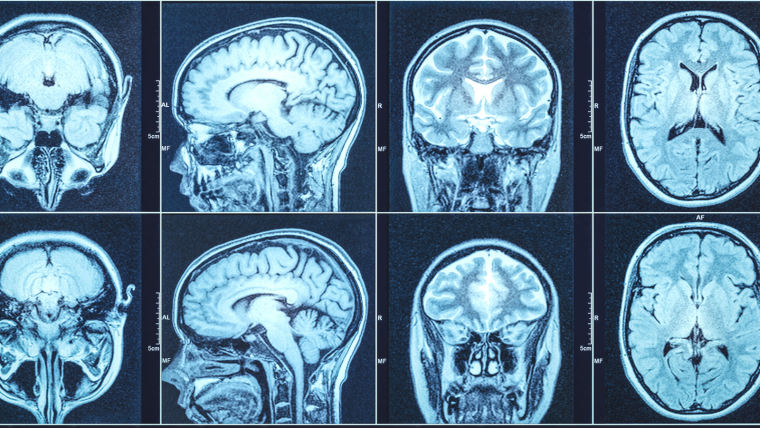 A variety of brain MRI scans from different angles on a screen