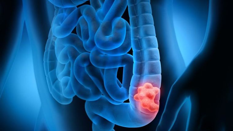 Colorectal cancer being highlighted in the body