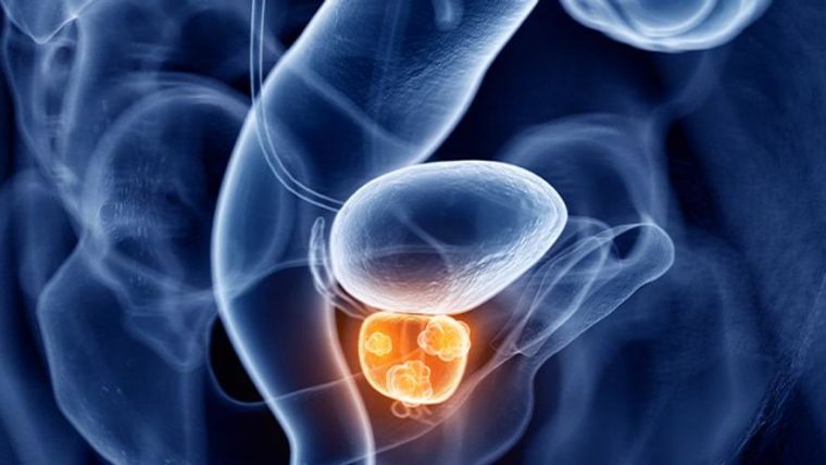Prostate cancer being highlighted in the body