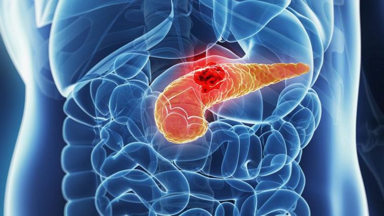 Pancreatic Cancer highlighted in the body